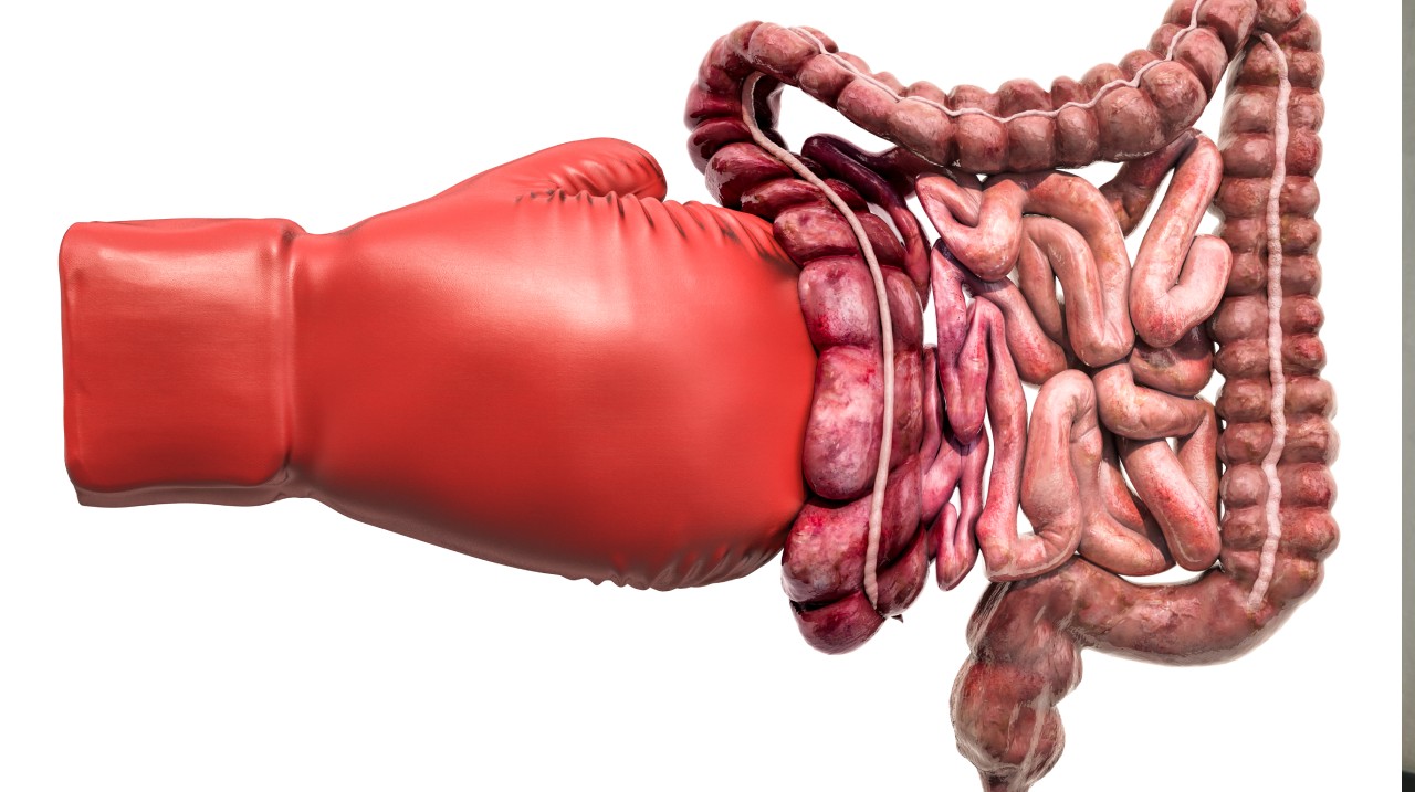 Superior Mesenteric Artery Syndrome - SMAS متلازمة الشريان المساريقي العلوي