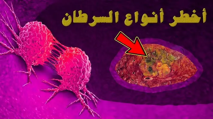 أصعب-أنواع-السرطان